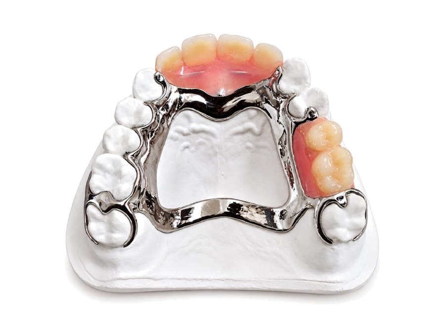 An upper chrome partial denture on a slim polished cobalt-chrome framework with an open palate, shown on a model.